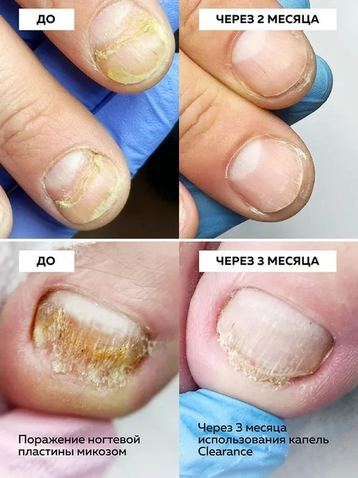 Капли от грибка ногтей на ногах, 30 мл, фото 2